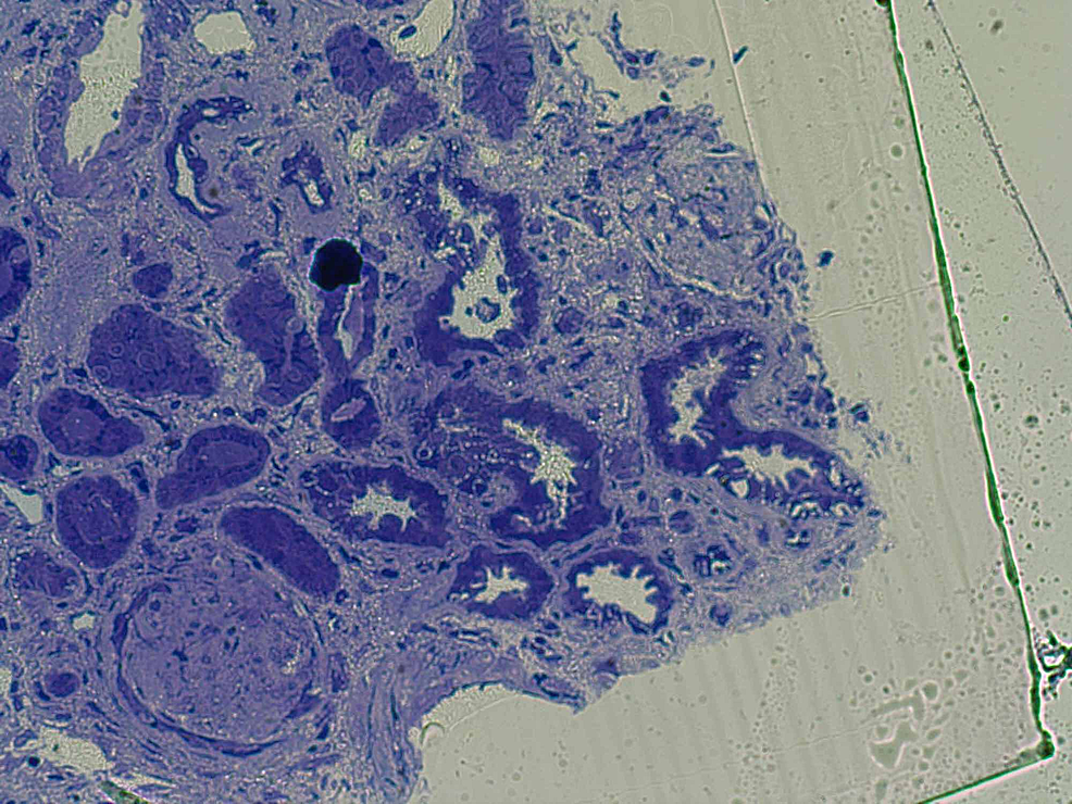 Electron-microscopy-shows-global-glomerular-sclerosis