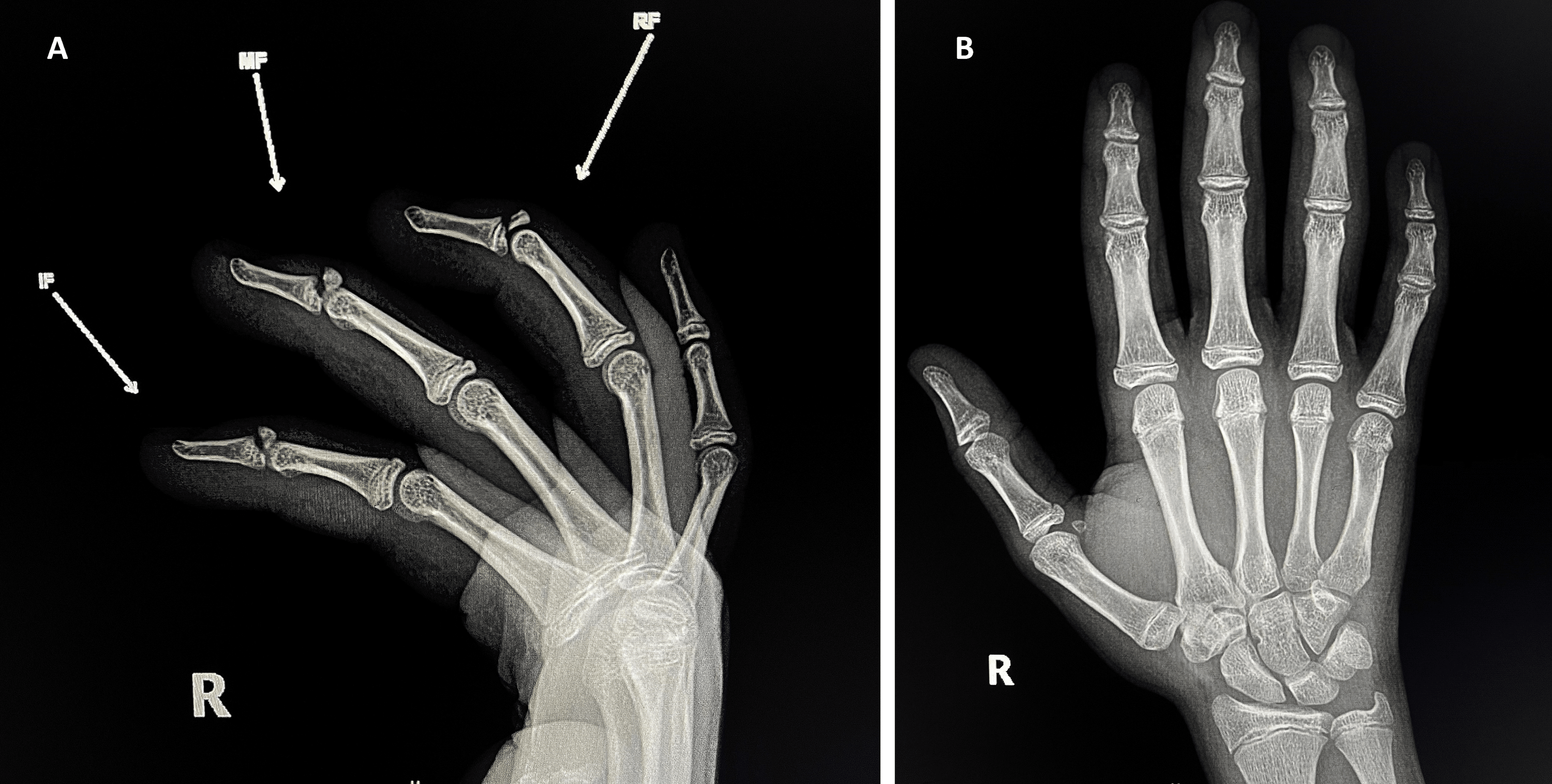 Cureus Multiple Bony Mallet Finger Injuries in One Hand of a 14Year