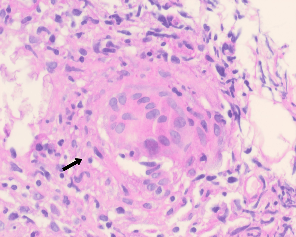 cureus-a-rare-presentation-of-sarcoidosis-in-a-young-male-with-acute