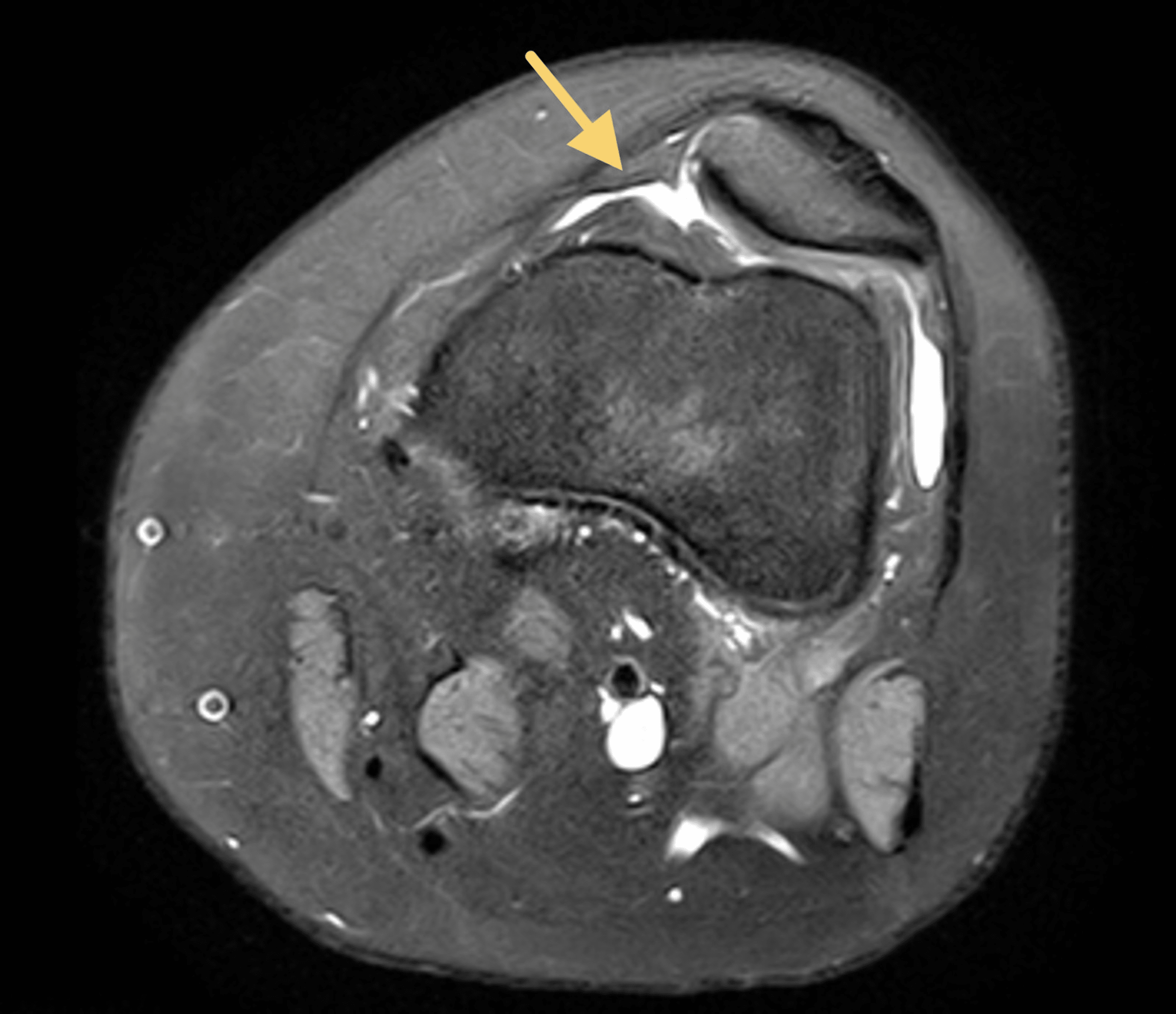 Interdisciplinary Orthopedic Management Of Pediatric Patella 