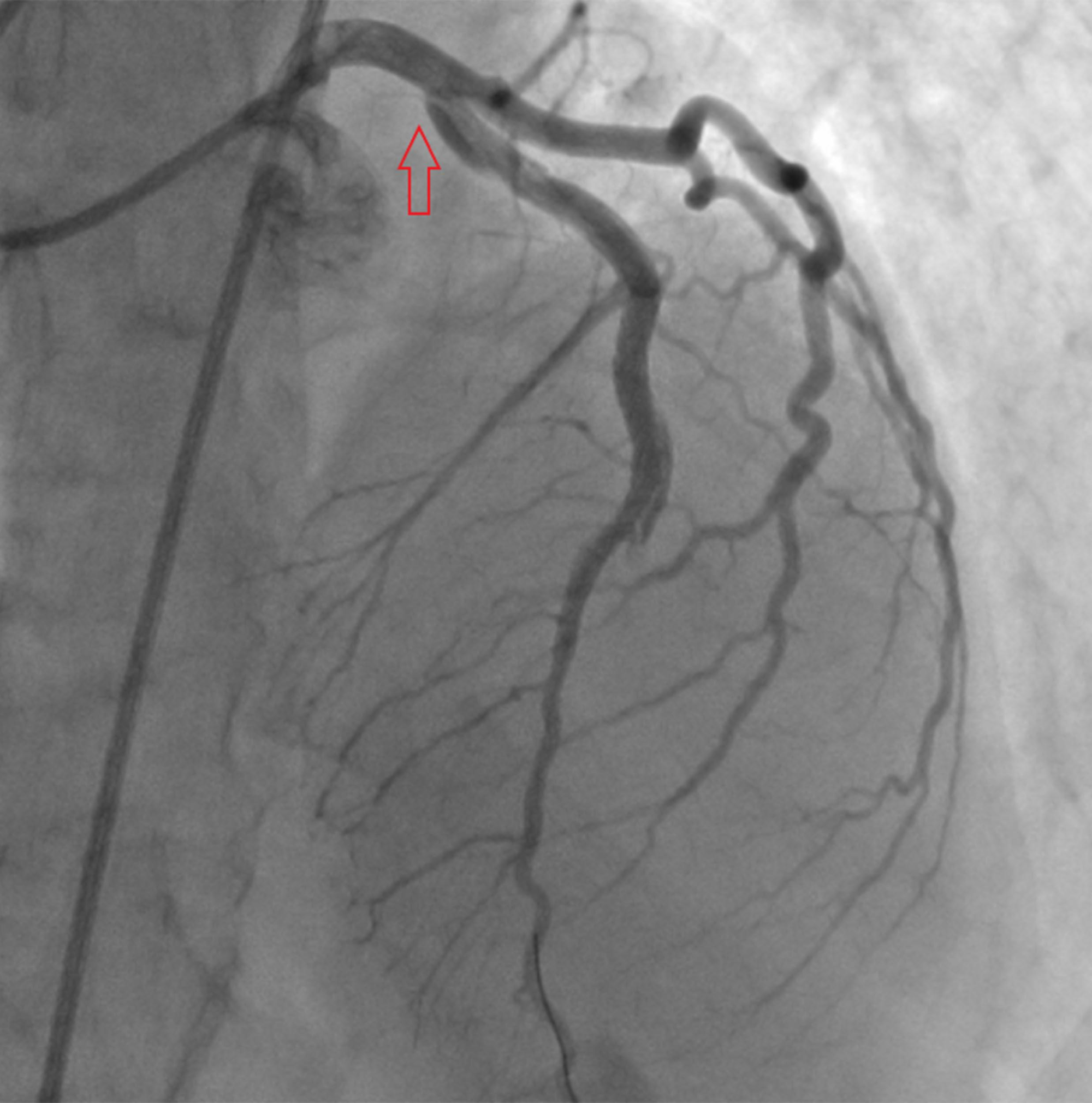 coronary-artery-dissection