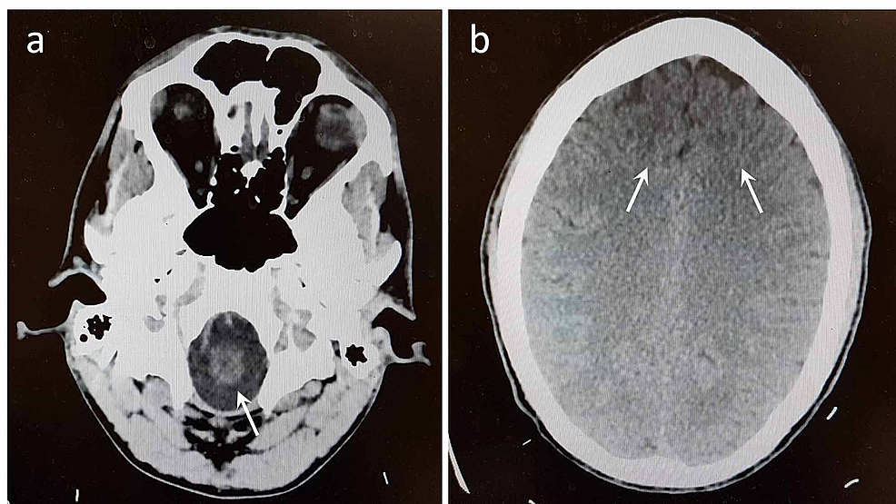 Cureus Phenibut Addiction In A Patient With Substance Use Disorder