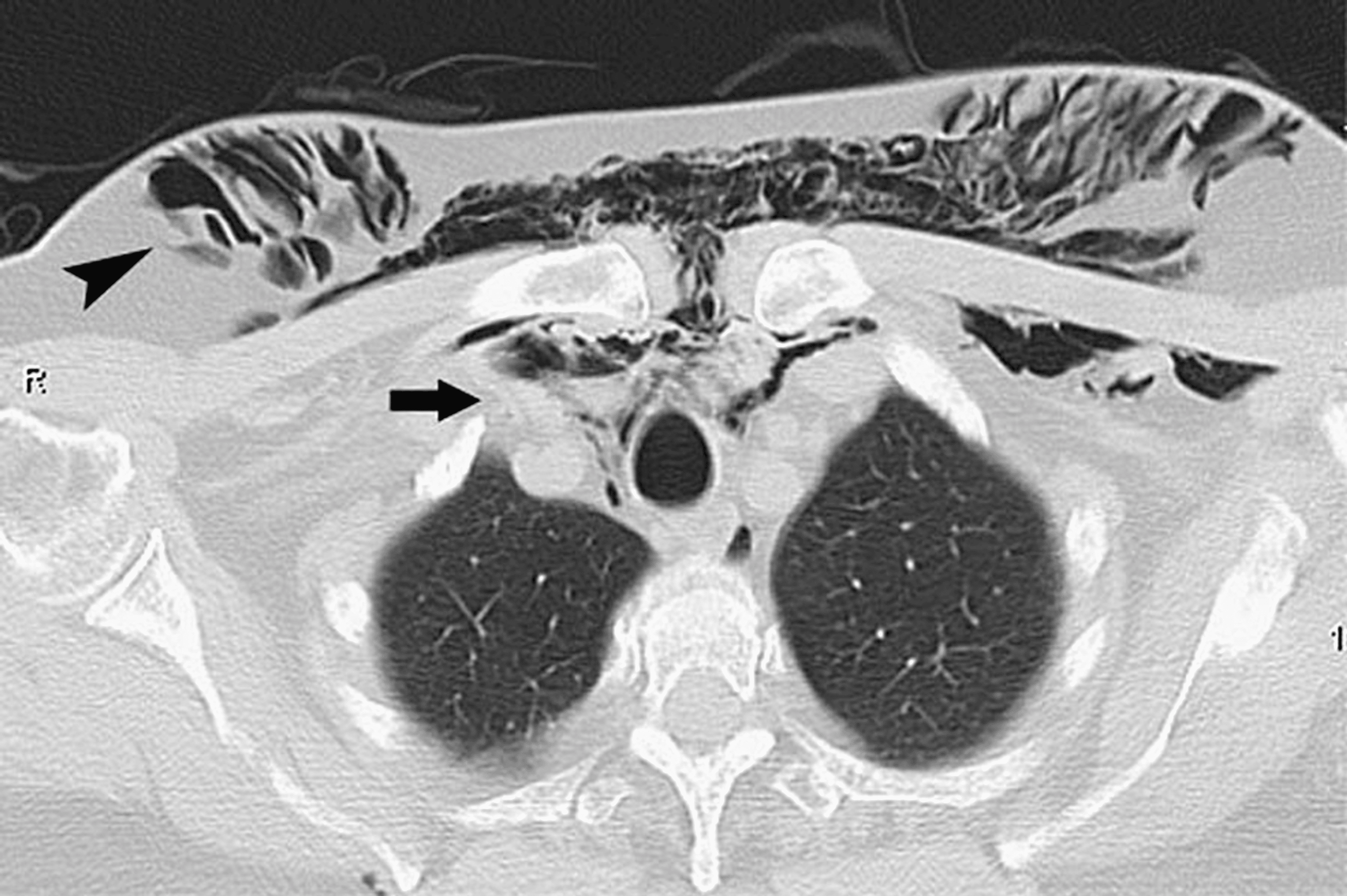 Cureus Pneumatosis Appearances On CT Imaging cureus-pneumatosis-appearances-on-ct-imaging