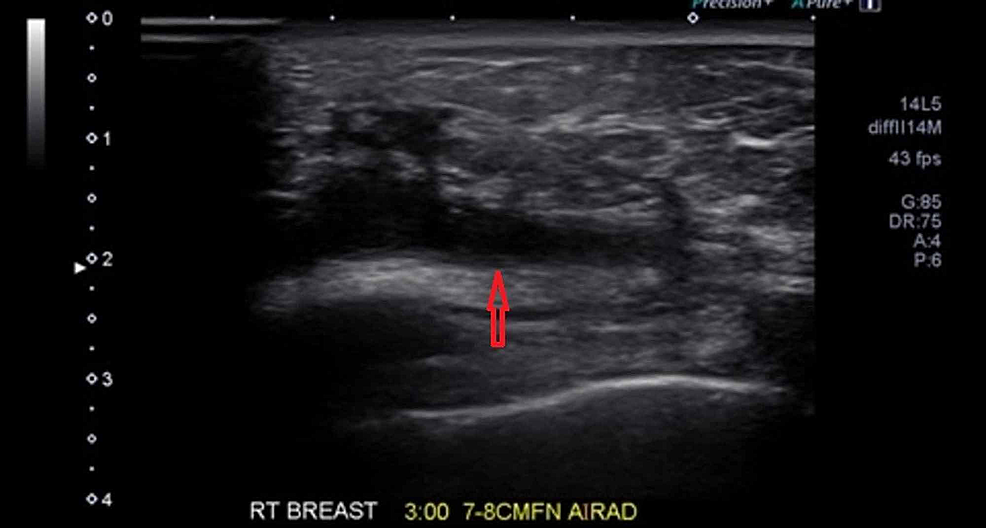 Cureus | Granulomatous Mastitis: A Rare Case with Sjogren’s Syndrome ...