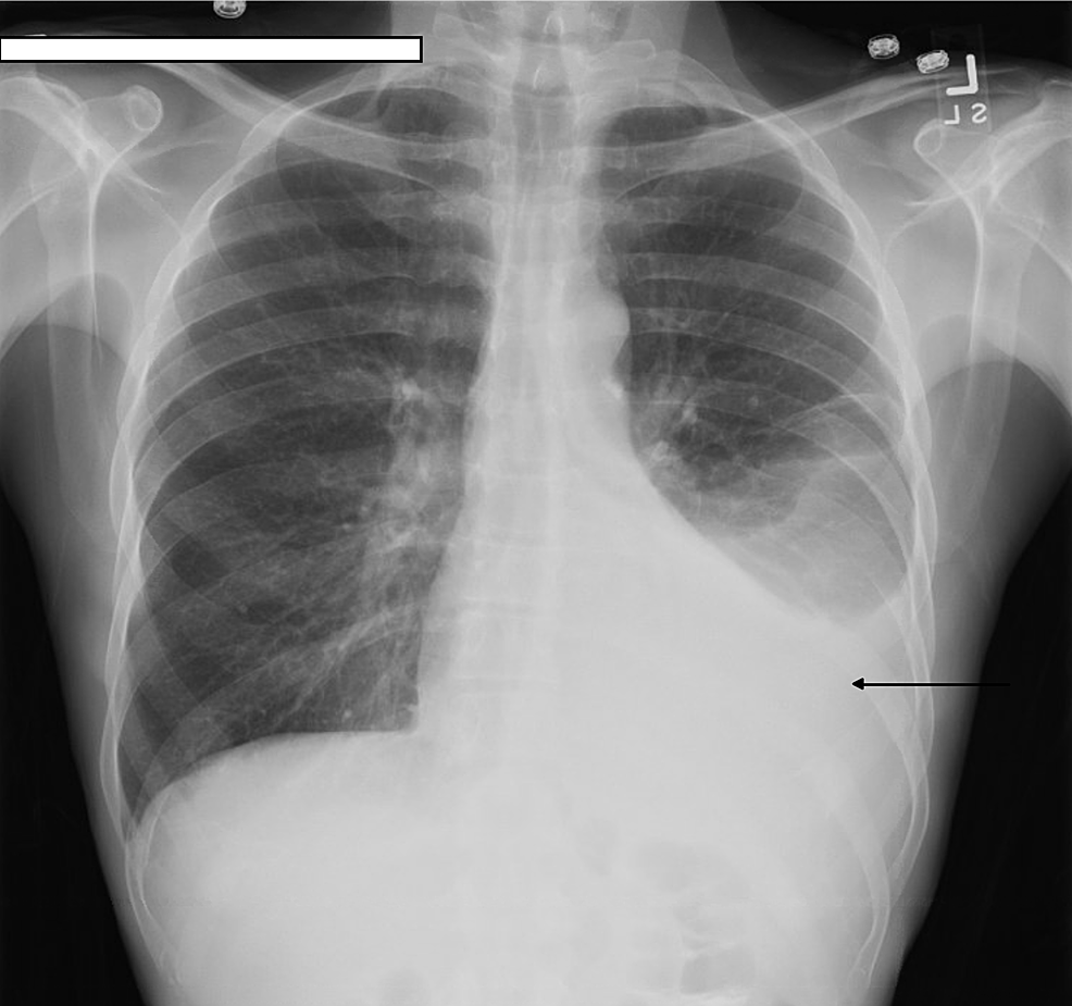 Cureus | Pancreaticopleural Fistula: A Rare Presentation and a Rare ...