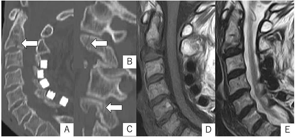 Odontoid and hangman fracture