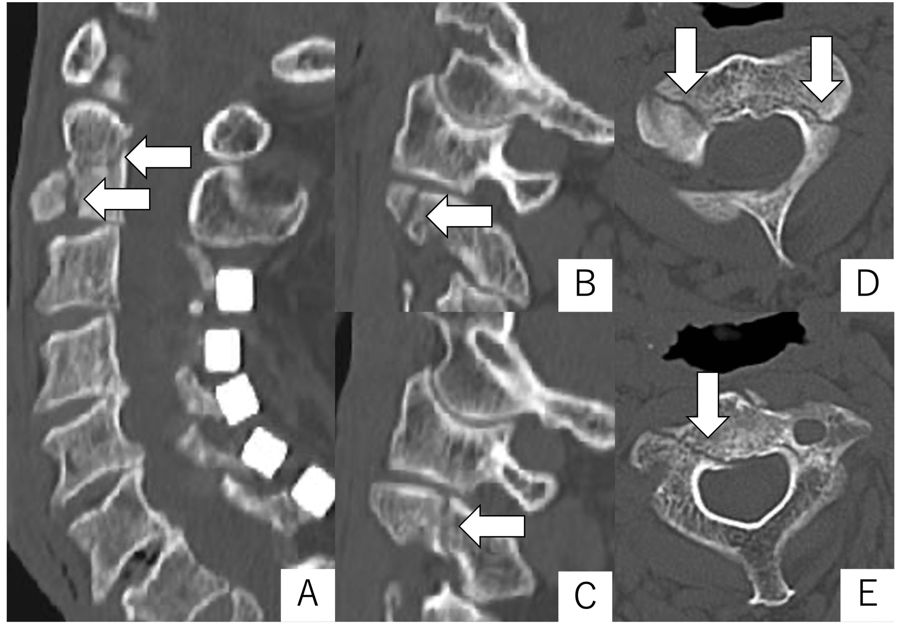 cureus-direct-screw-osteosynthesis-for-an-elderly-osteoporotic