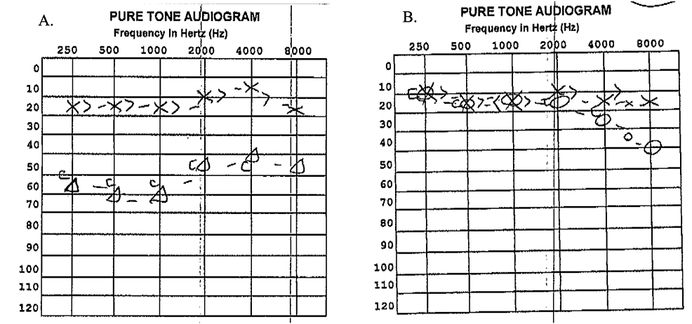 Cureus Vascular Loop Of The Anterior Inferior Cerebellar Artery Aica As A Cause Of