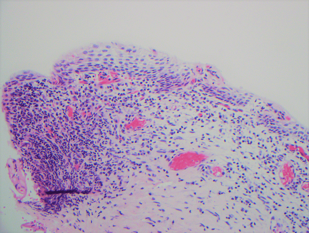 An 11-year-old girl with biopsy-proven juvenile (virginal) breast