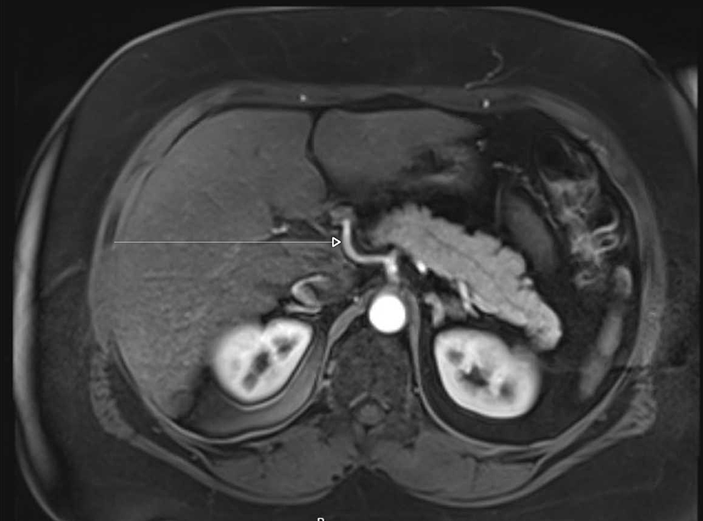 Magnetic-resonance-cholangiopancreatography-shows-no-choledocholithiasis,-or-pancreatic-mass-to-correlate-with-the-patient's-pancreatitis.