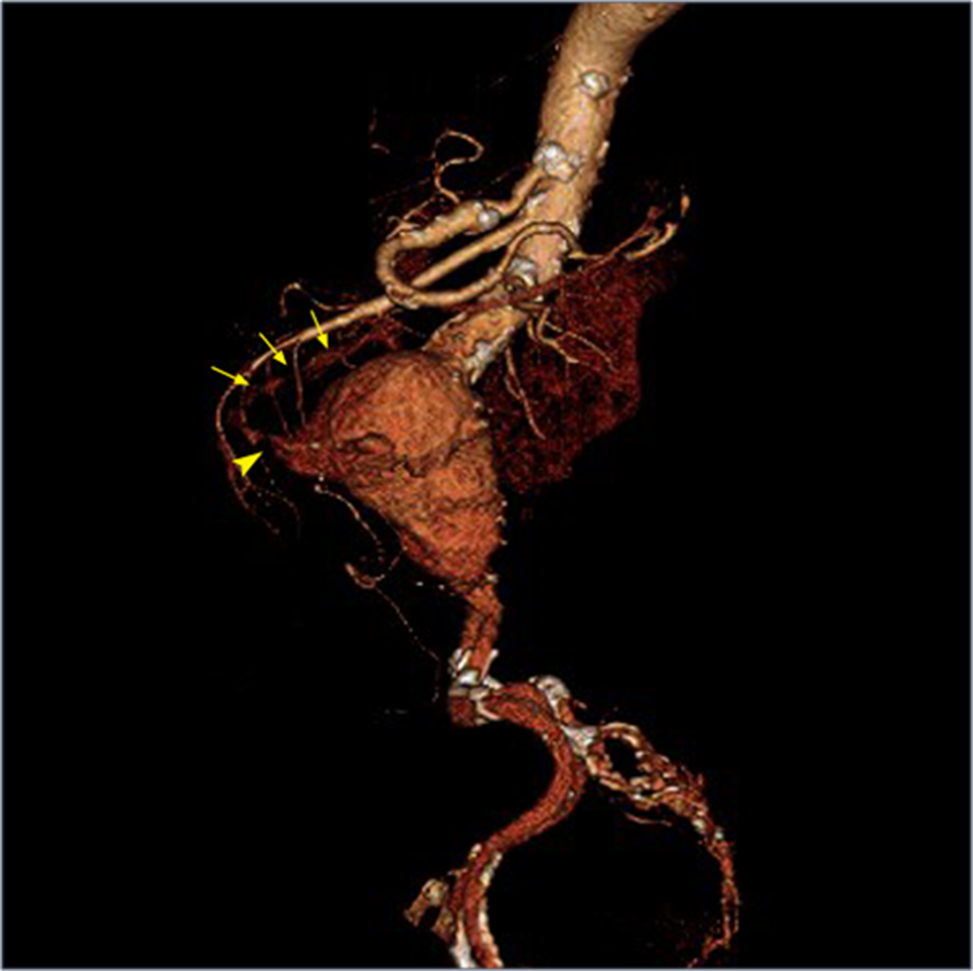 Cureus | Primary Aortoenteric Fistula: A Rare Case of a Massive ...