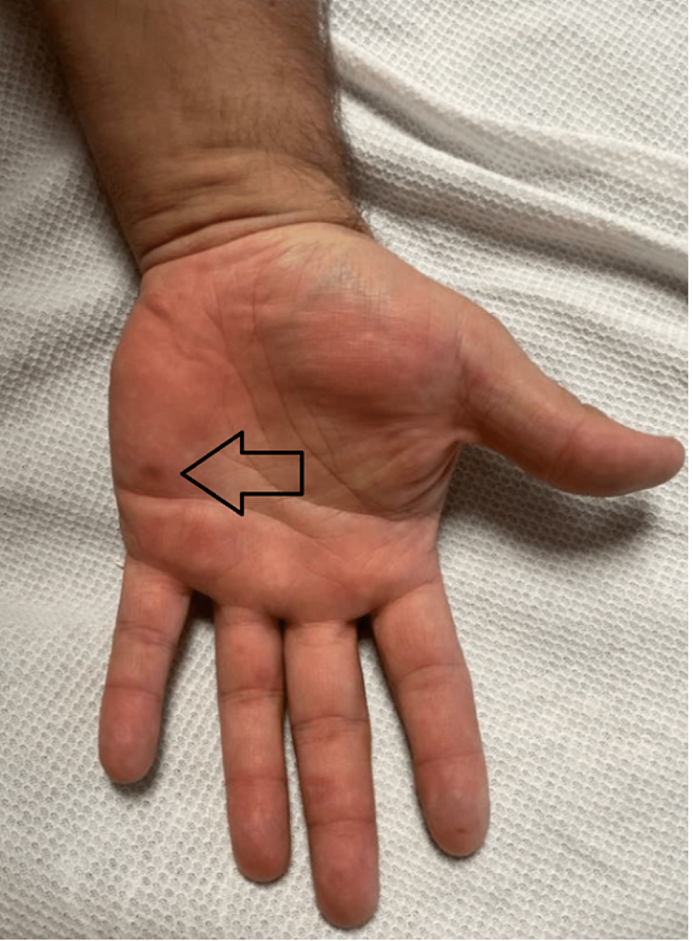 Cureus A Case Of Hand Foot And Mouth Disease In An Adult Male   Article River 49c9c78024c211ee98397131f1c4d750 Hand 1   900 Pixels 