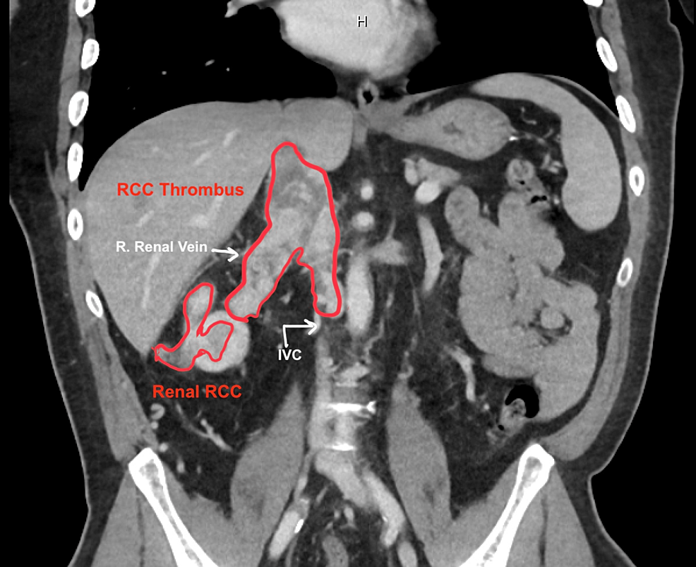 laparoscopic-radical-nephrectomy-for-renal-cancer-urologist