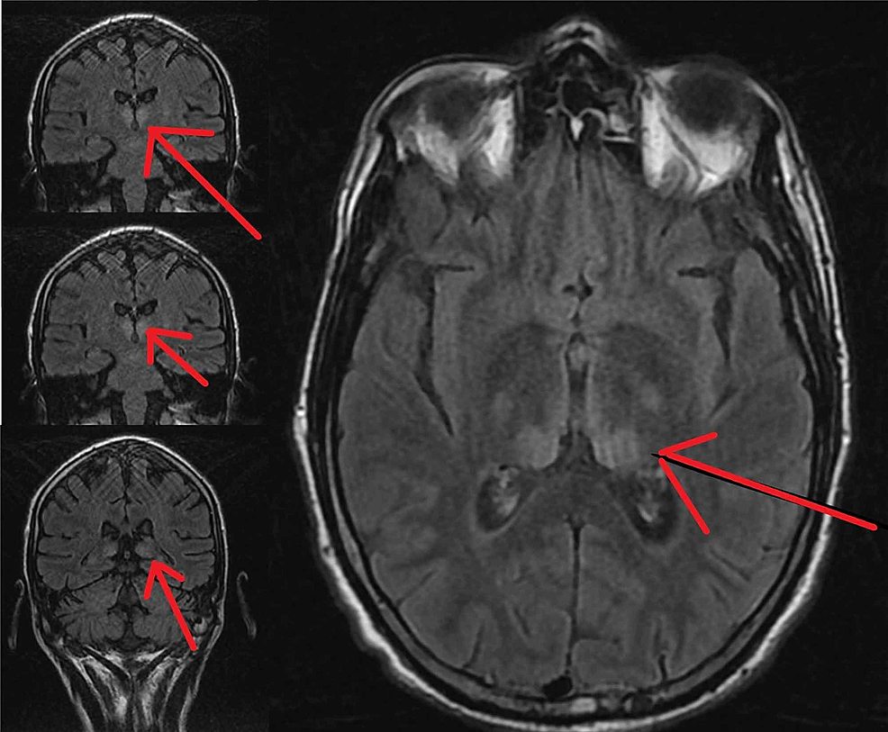 T2-FLAIR-MRI-of-the-brain