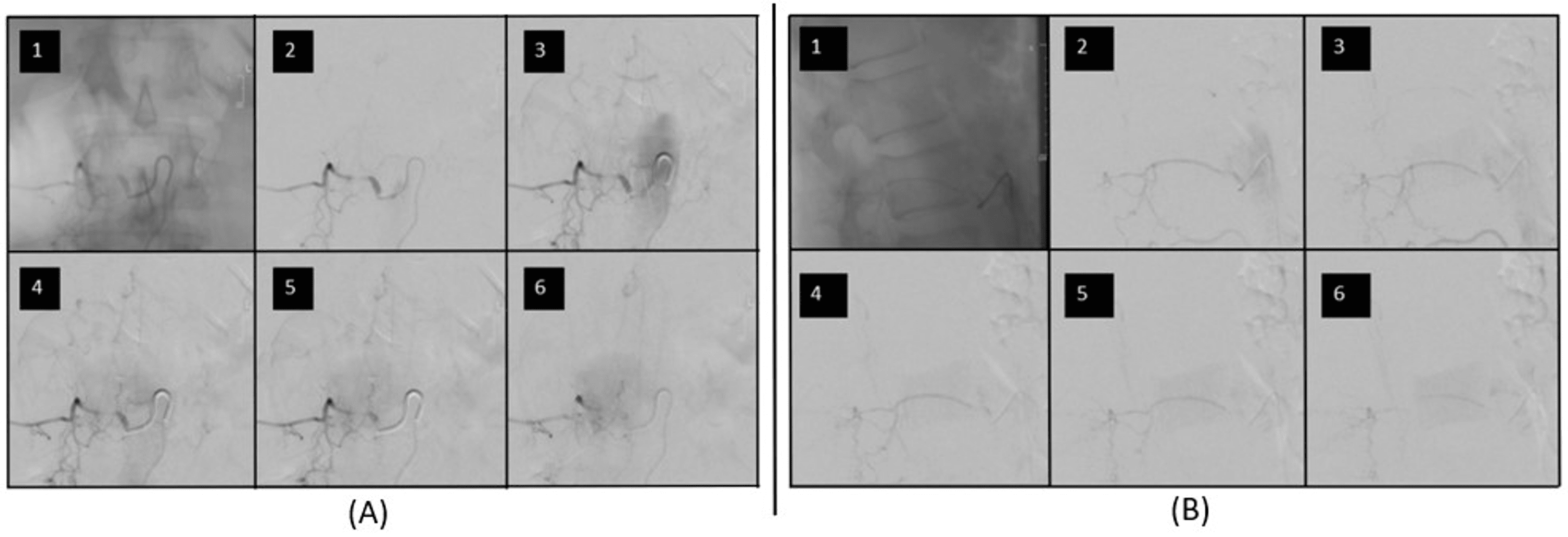 Cureus | Exploring Spinal Subarachnoid Hemorrhage: A Neurosurgical Case ...