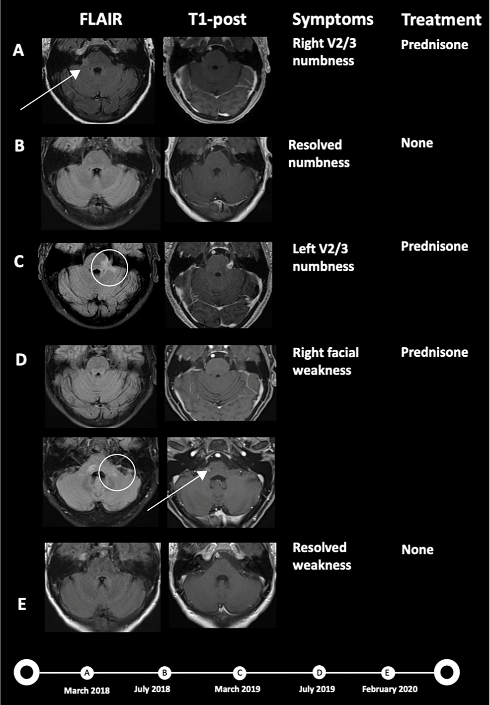 Cureus, Brainstem and Spinal Arachnoiditis Ossificans Associated With  Neurocysticercosis: A Case Report