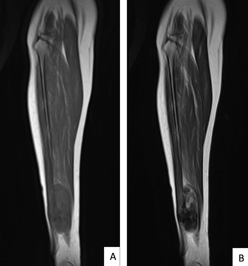 Distal Tibiofibular Joint Reconstruction Using Autograft in a Rare Case ...