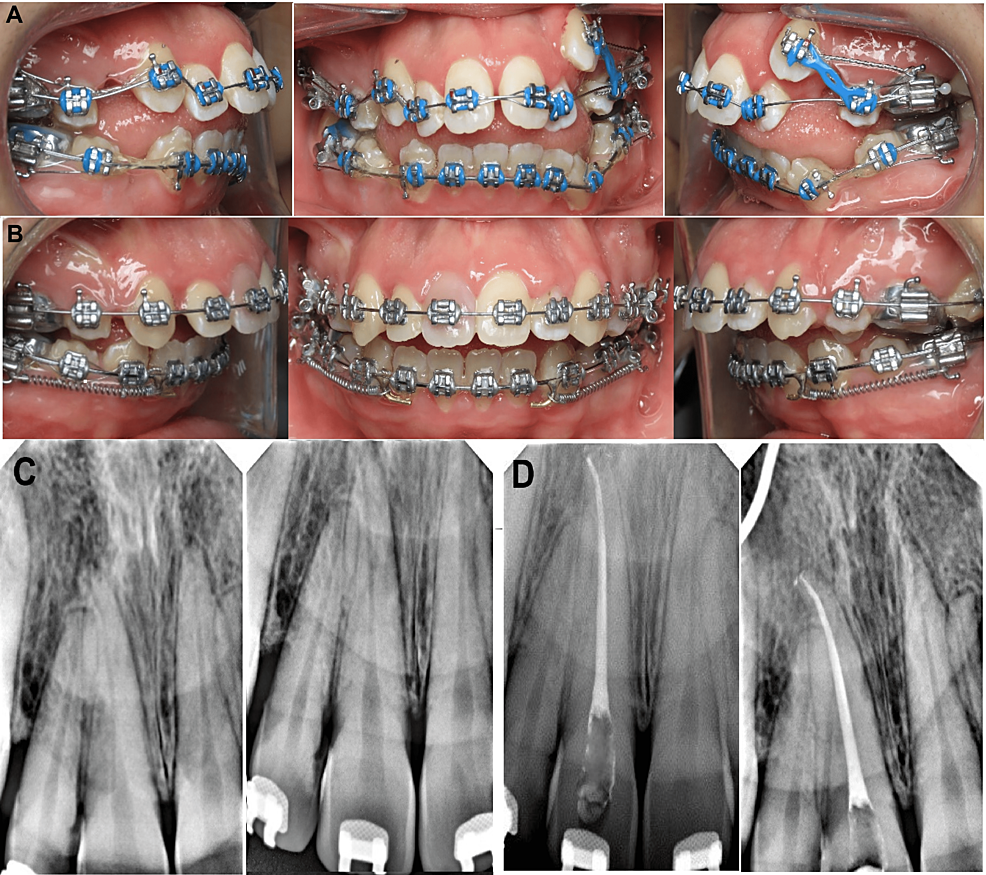 Cureus | Necrotic Pulp With Crown Discoloration Associated With ...