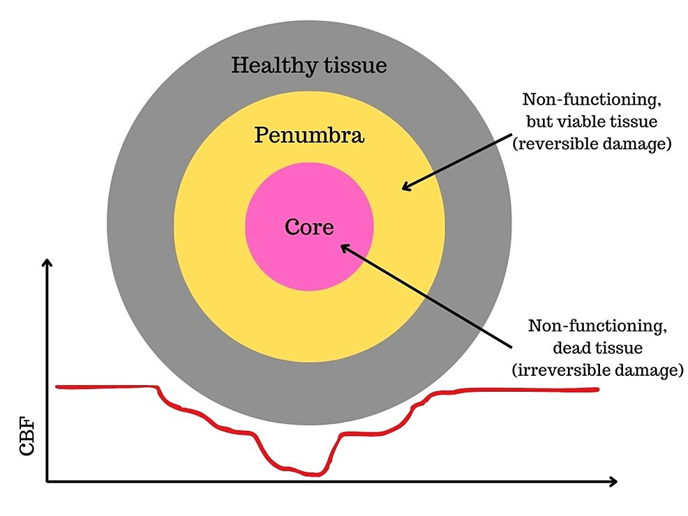 Mechanical Thrombectomy in Nighttime Hours: Is There a Difference