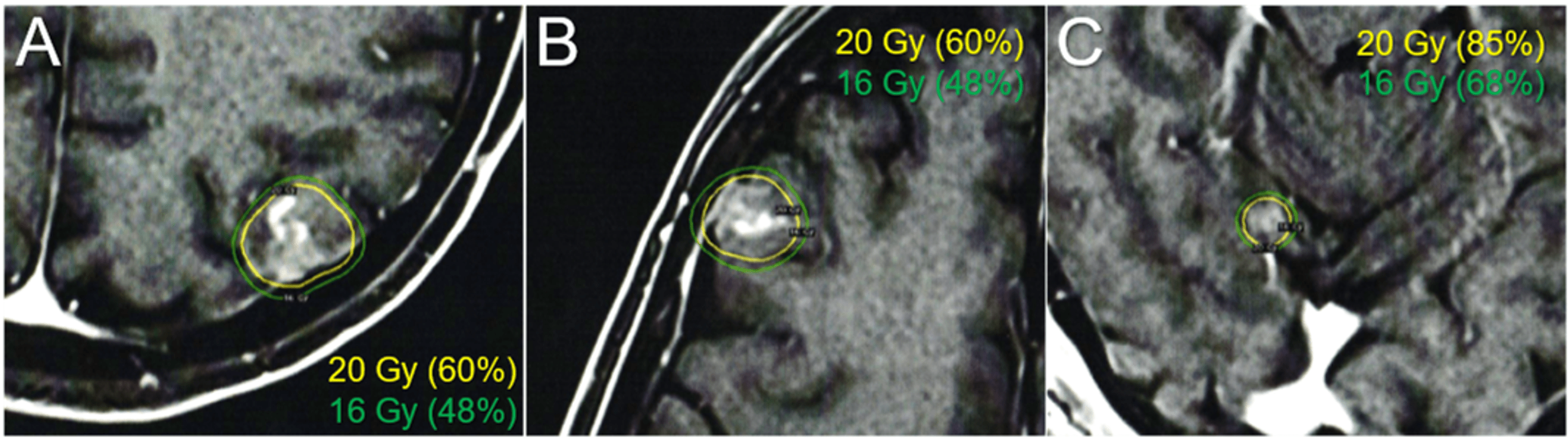 Cureus Volumetric Modulated Arc Based Re Radiosurgery With Simultaneous Reduced Dose Whole 