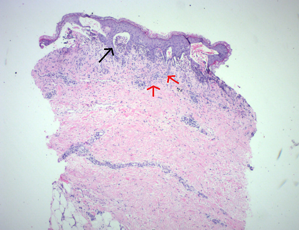 Skin-punch-biopsy-(40x-magnification)-with-superficial-inflammation-(red-arrows)-and-subepidermal-blister-formation-(black-arrow)