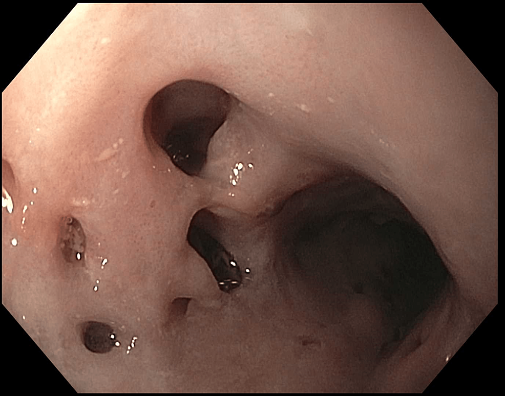 Esophageal diverticulum: Anatomy, Causes, Significance