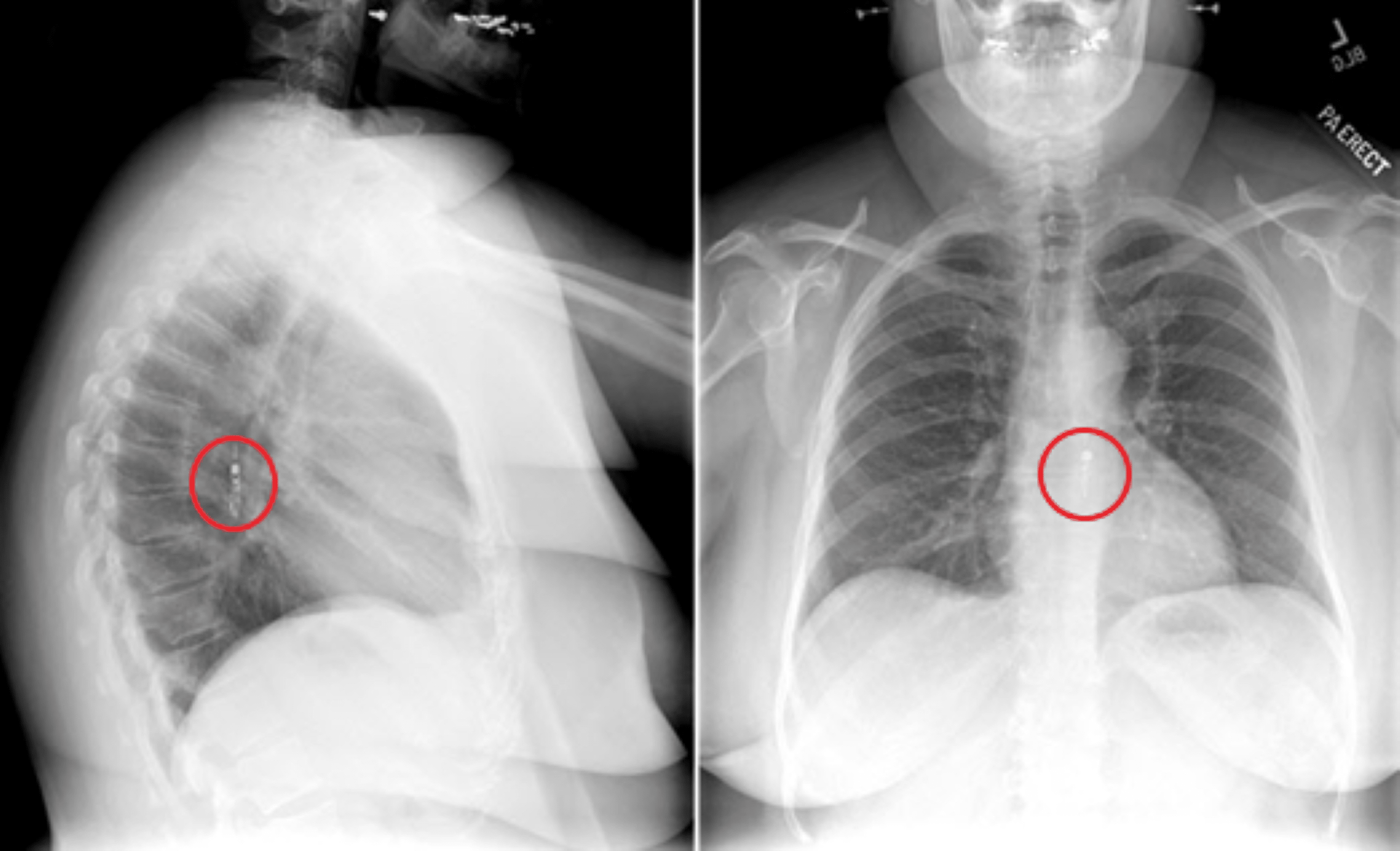 Cureus | Acute Chest Pain Following Bravo Device Placement