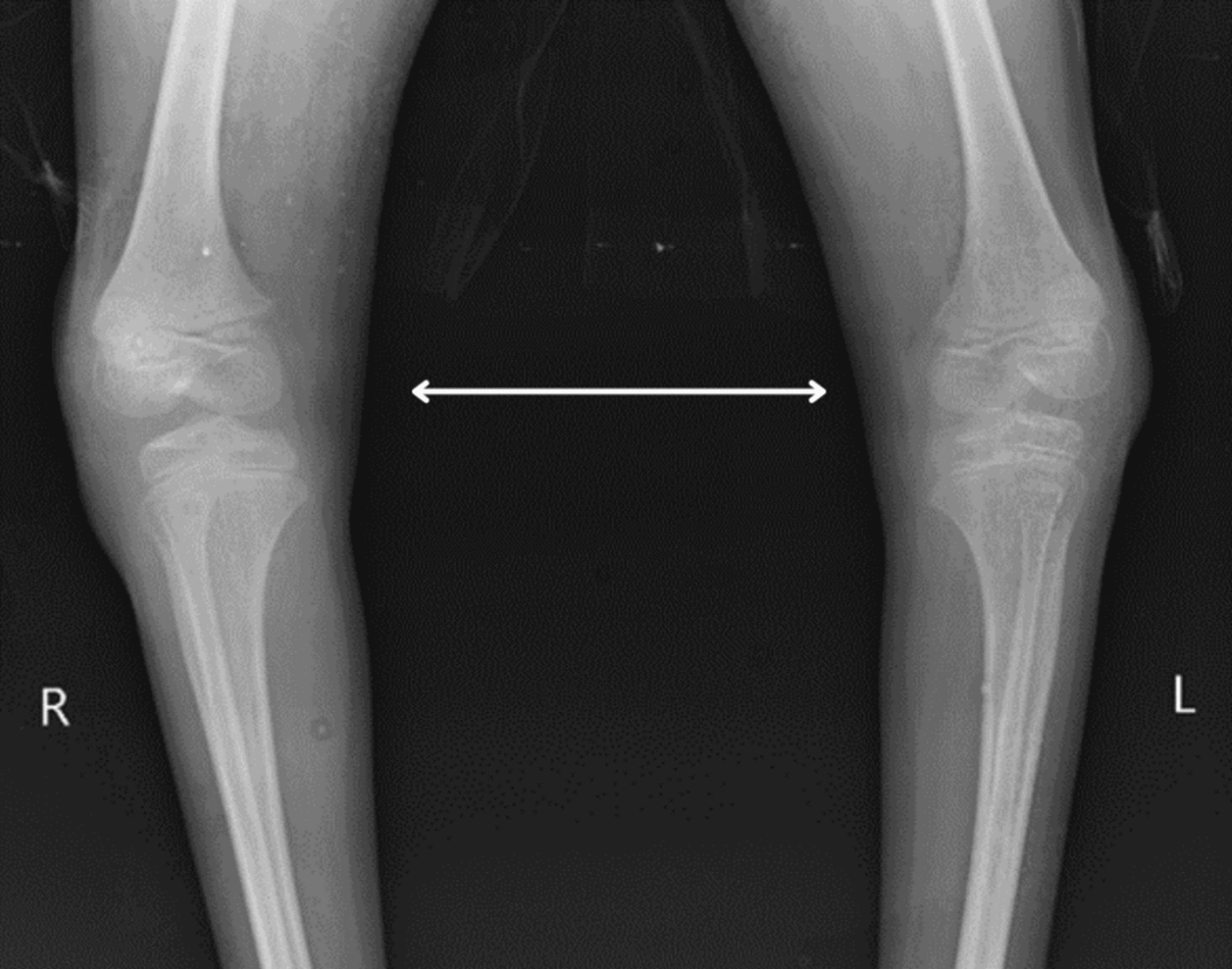 The Effectiveness of Physical Therapy Intervention in a SevenYearOld