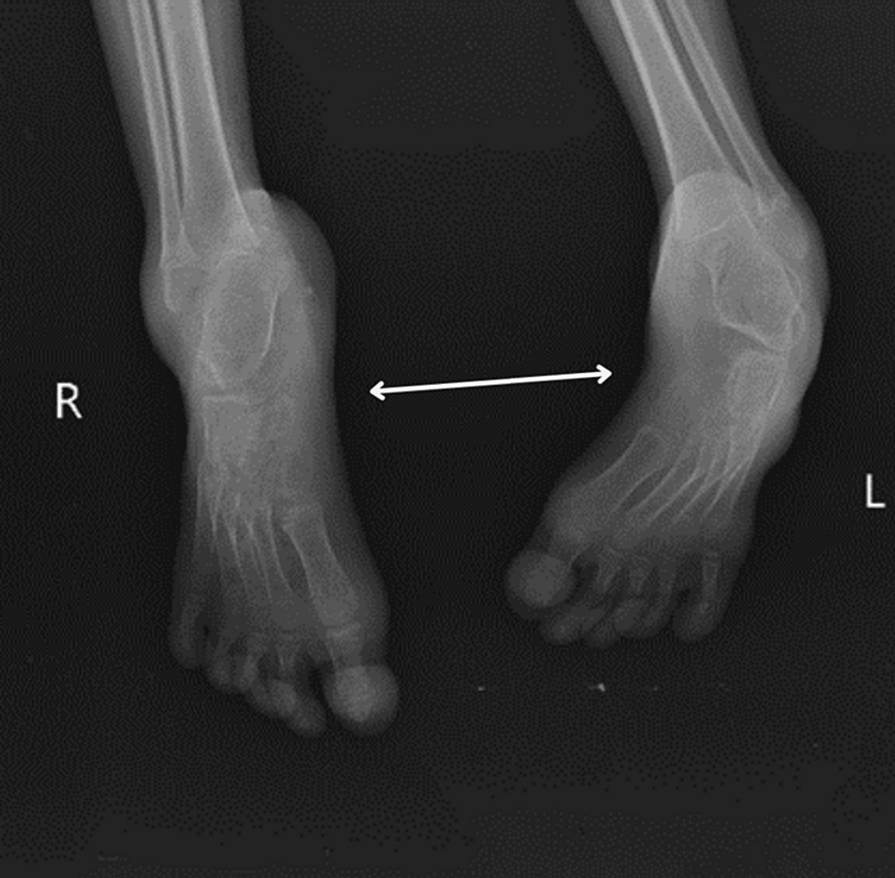 The Effectiveness of Physical Therapy Intervention in a SevenYearOld