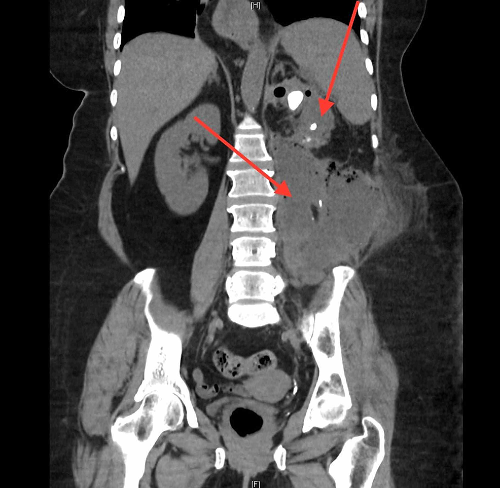 Cureus Perinephric Abscess Causing Mycotic Celiac and Splenic Artery