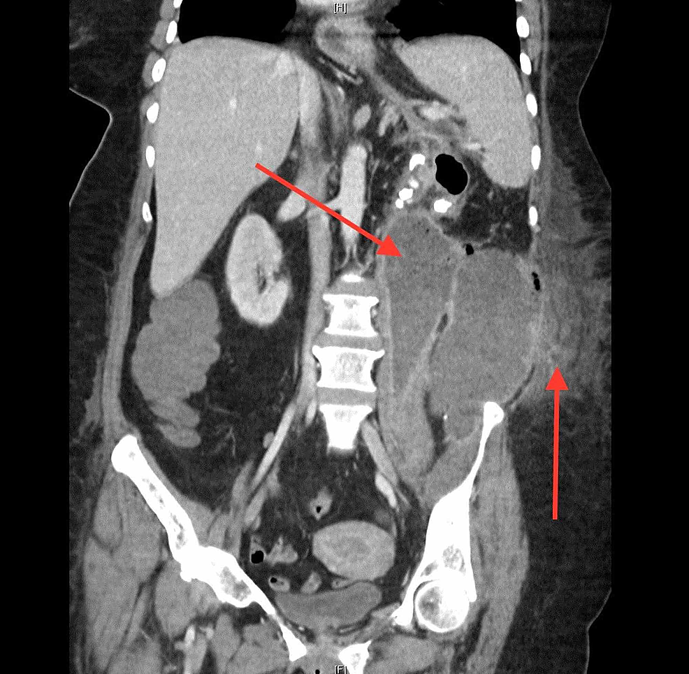 Subcutaneous Abscess Treatment