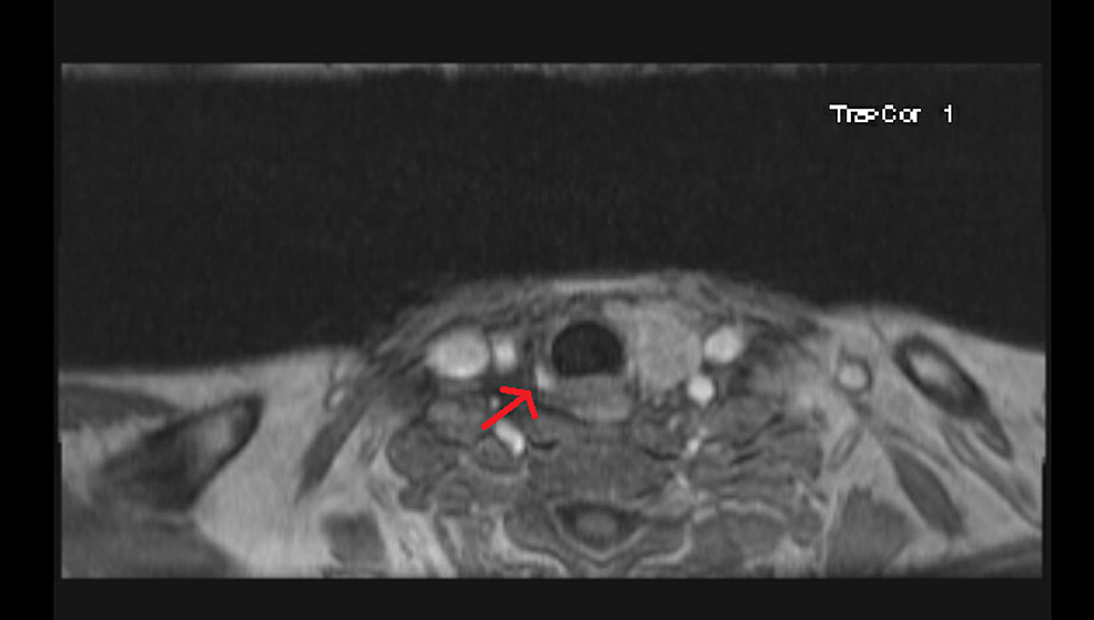 MRI-of-the-neck-with-contrast-showing-an-arterially-enhancing-nodule-(arrow)-in-the-region-of-the-right-thyroid-resection-bed-suggestive-of-parathyroid-adenoma.