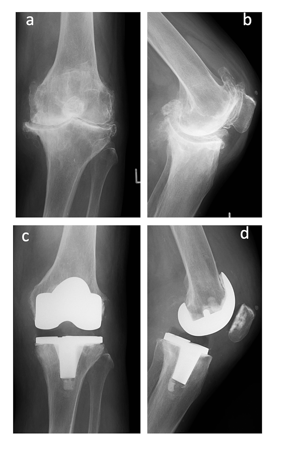 Cureus | Catastrophic Mid-Flexion Instability After Avulsion Fractures ...