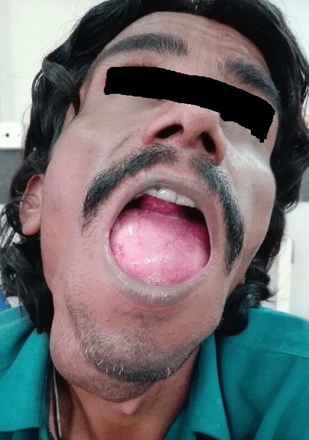 Cureus An Unusual Case Of Sublingual Epidermoid Cyst Mimicking Plunging Ranula