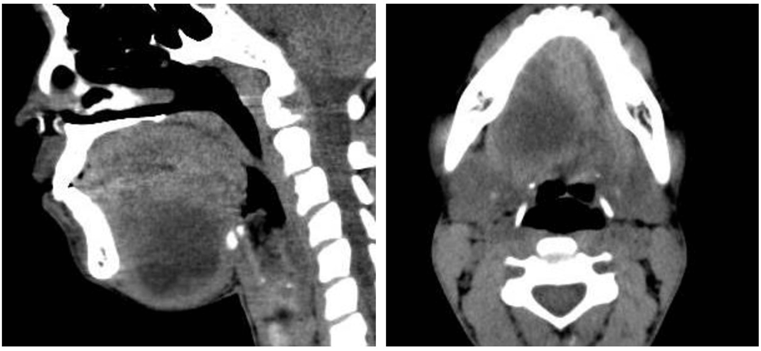 Cureus A Giant Epidermoid Cyst In The Floor Of Mouth Mimicking Ranula