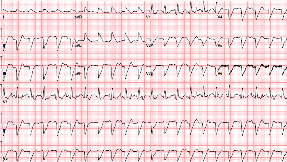 Cureus | Acute Myocarditis Presenting as Acute Coronary Syndrome