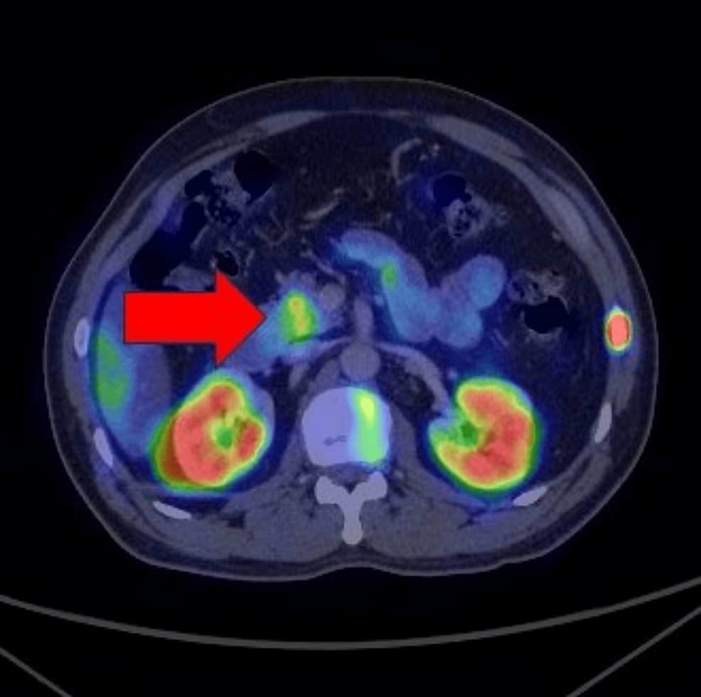 cureus-a-case-of-pancreatic-neuroendocrine-tumor-with-extensive