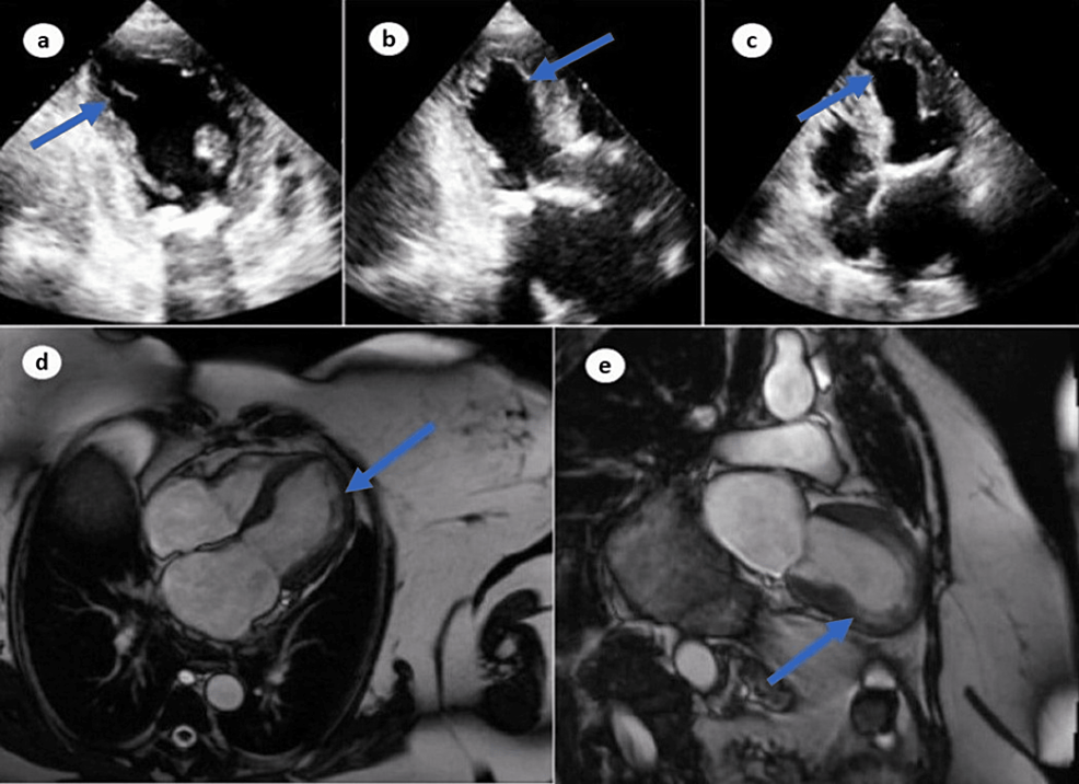 Echocardiogram-revealing-apical-ballooning-of-heart-(a-c)-and-cardiac-ventriculogram-revealing-apical-ballooning-ruling-out-myocarditis-(d,-e).