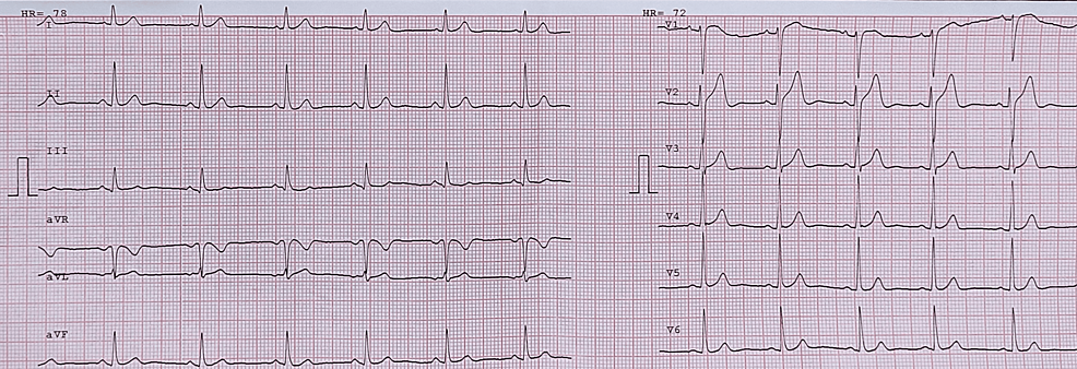 Electrocardiogram-revealing-unremarkable-changes-on-recent-visit.