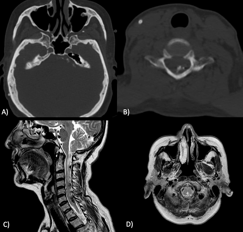 Cureus, Brainstem and Spinal Arachnoiditis Ossificans Associated With  Neurocysticercosis: A Case Report
