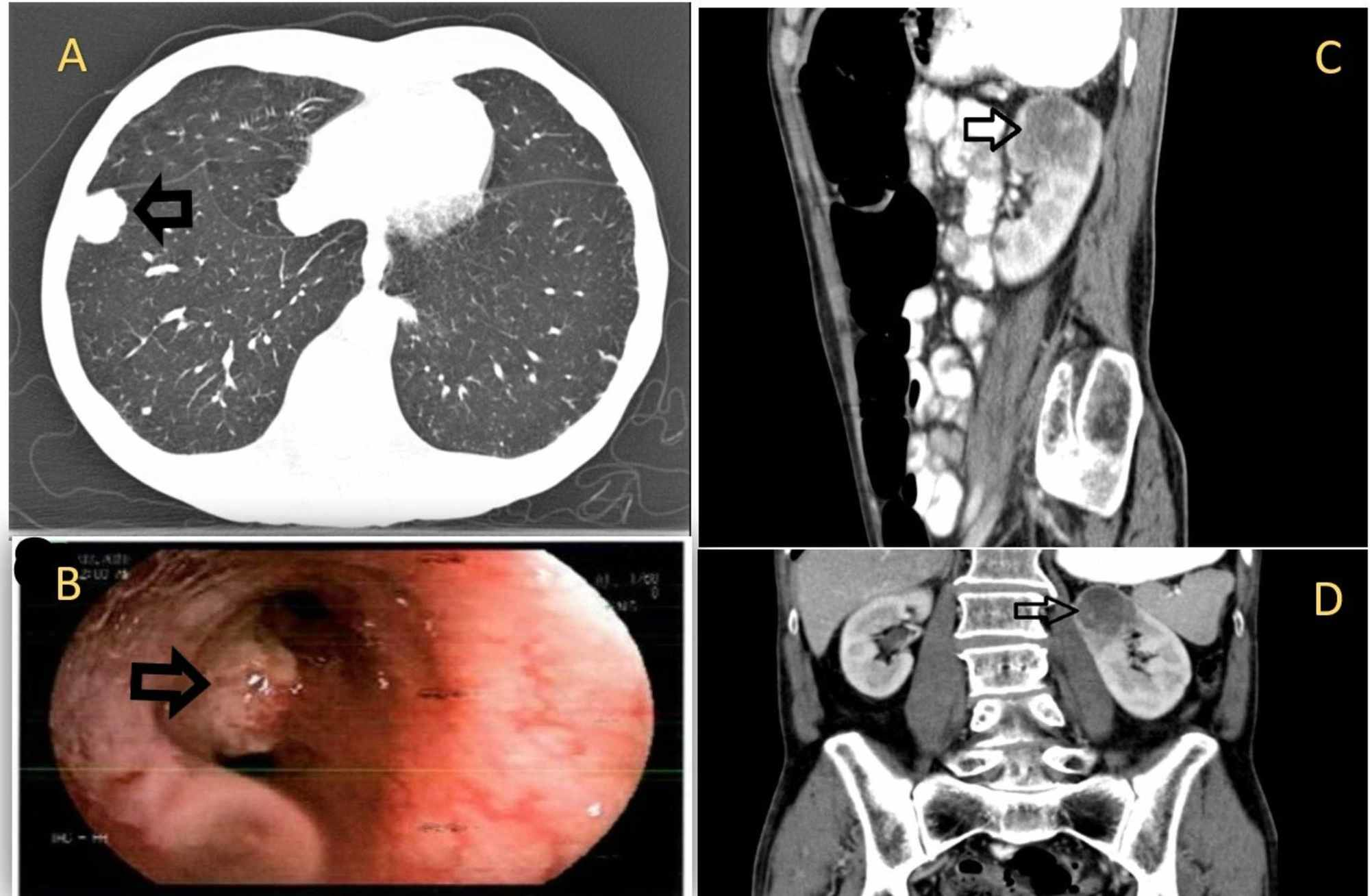 Cureus Isolated Renal Metastasis From Primary Lung Squamous Cell