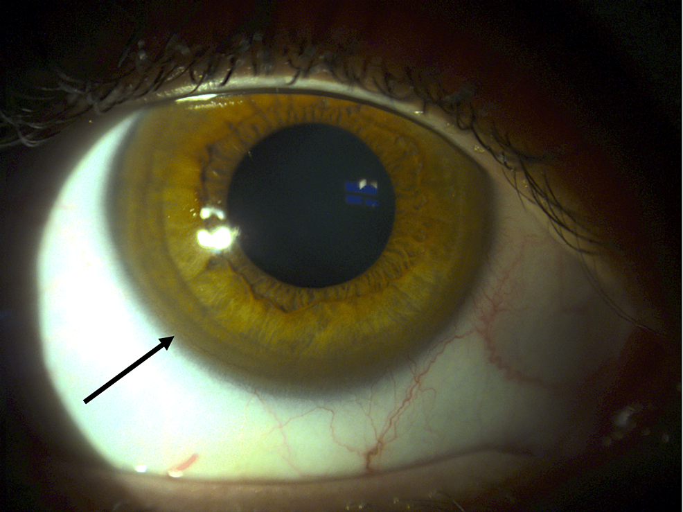 Figure 3 from An Algorithm to Detect Kayser-Fleischer Ringin Human Eye for  Diagnosing Wilson Disease | Semantic Scholar