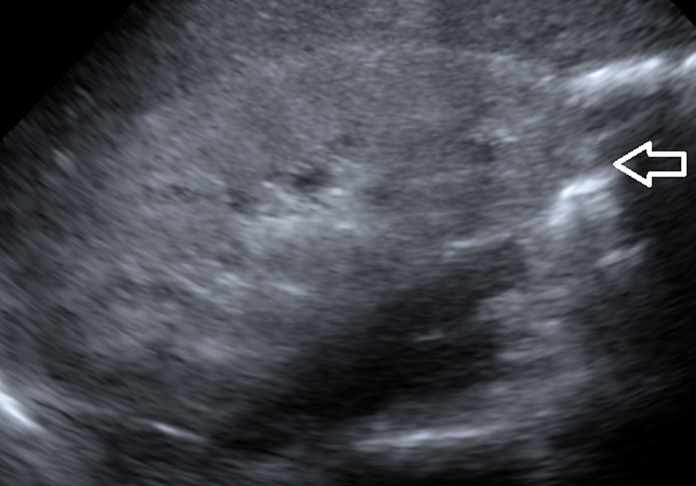 Ultrasound-right-kidney