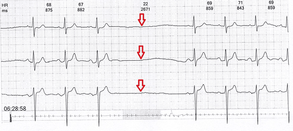 Married To The Pacemaker: An Autobiographical Case Report Of Sick Sinus 