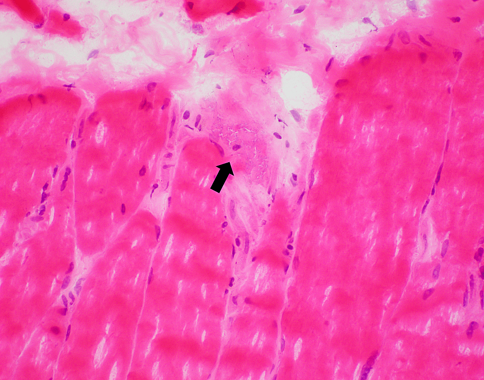 cureus-dysphagia-a-case-report-of-an-atypical-presentation-of-statin