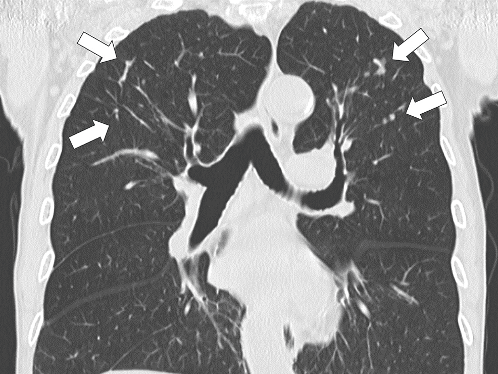 MycobacteriumInduced Reactive Arthritis in an Older Adult With