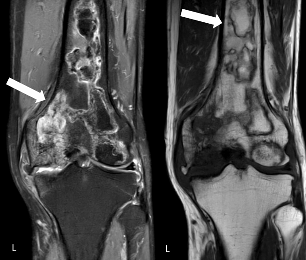 Cureus | Spontaneous Osteonecrosis of Knee: A Case Report