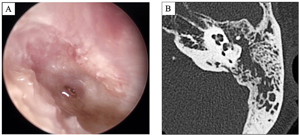 Cureus | An Otogenic Variant of Lemierre's Syndrome Caused by ...