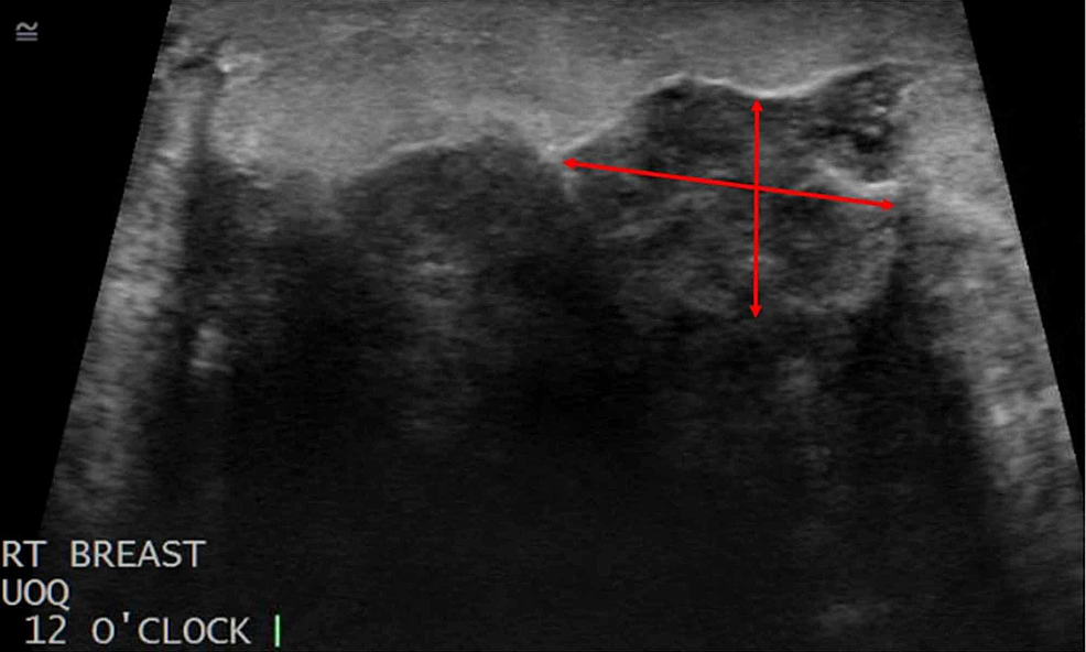 Black Spots On Breast Ultrasound