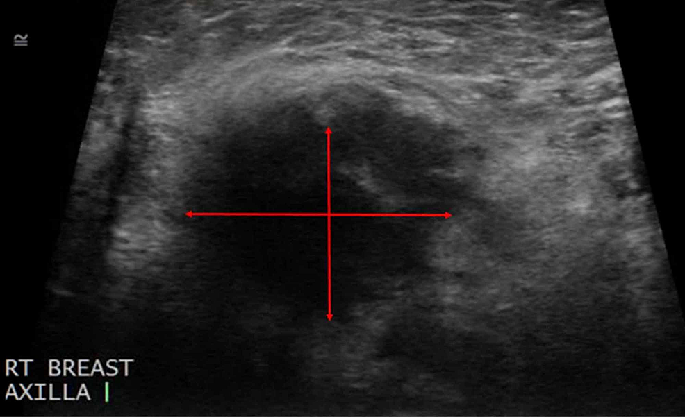 Cureus | Diagnosis and Management of Metastatic Breast Cancer in a 33 ...